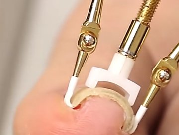 Batık Tırnak Düzeltme Aparatı