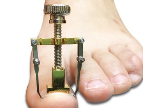 Batık Tırnak Düzeltme Aparatı